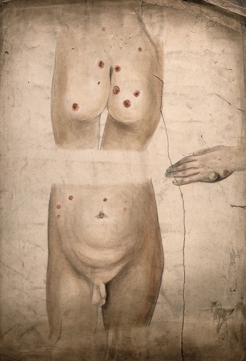 Sores and abcesses (?) on the buttocks and abdomen of a boy suffering from syphilis, with a detail showing a large boil or abcess on the boy's hand. Watercolour by C. D'Alton, 18--. — D'Alton, Christopher, active 1847-1871