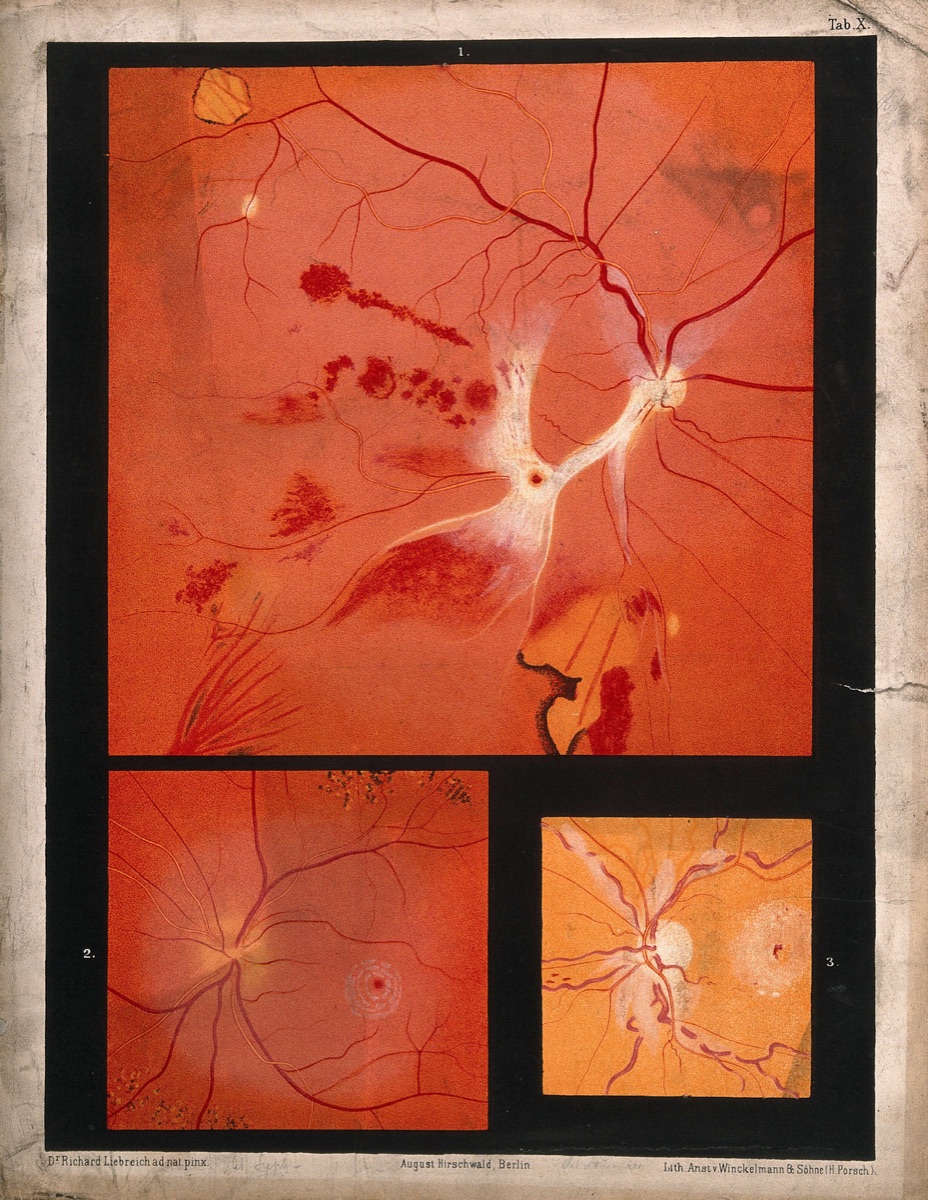 The eye, as seen through a microscope: three figures. Colour lithograph after R. Liebreich, ca. 1860. — Richard Liebreich