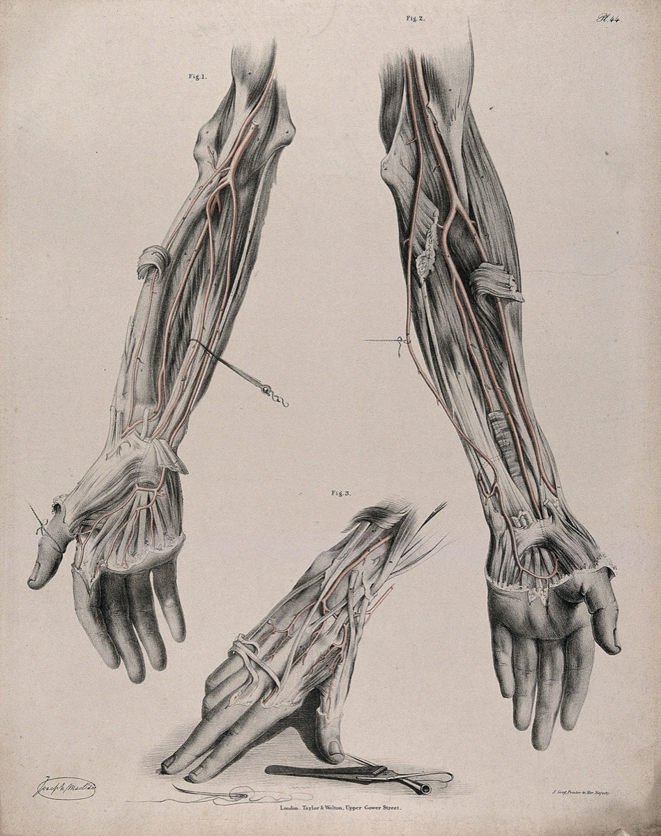 The circulatory system: dissections of the arm and hand, with the arteries indicated in red and surgical instruments shown below. Coloured lithograph by J. Maclise, 1841/1844. — Joseph Maclise