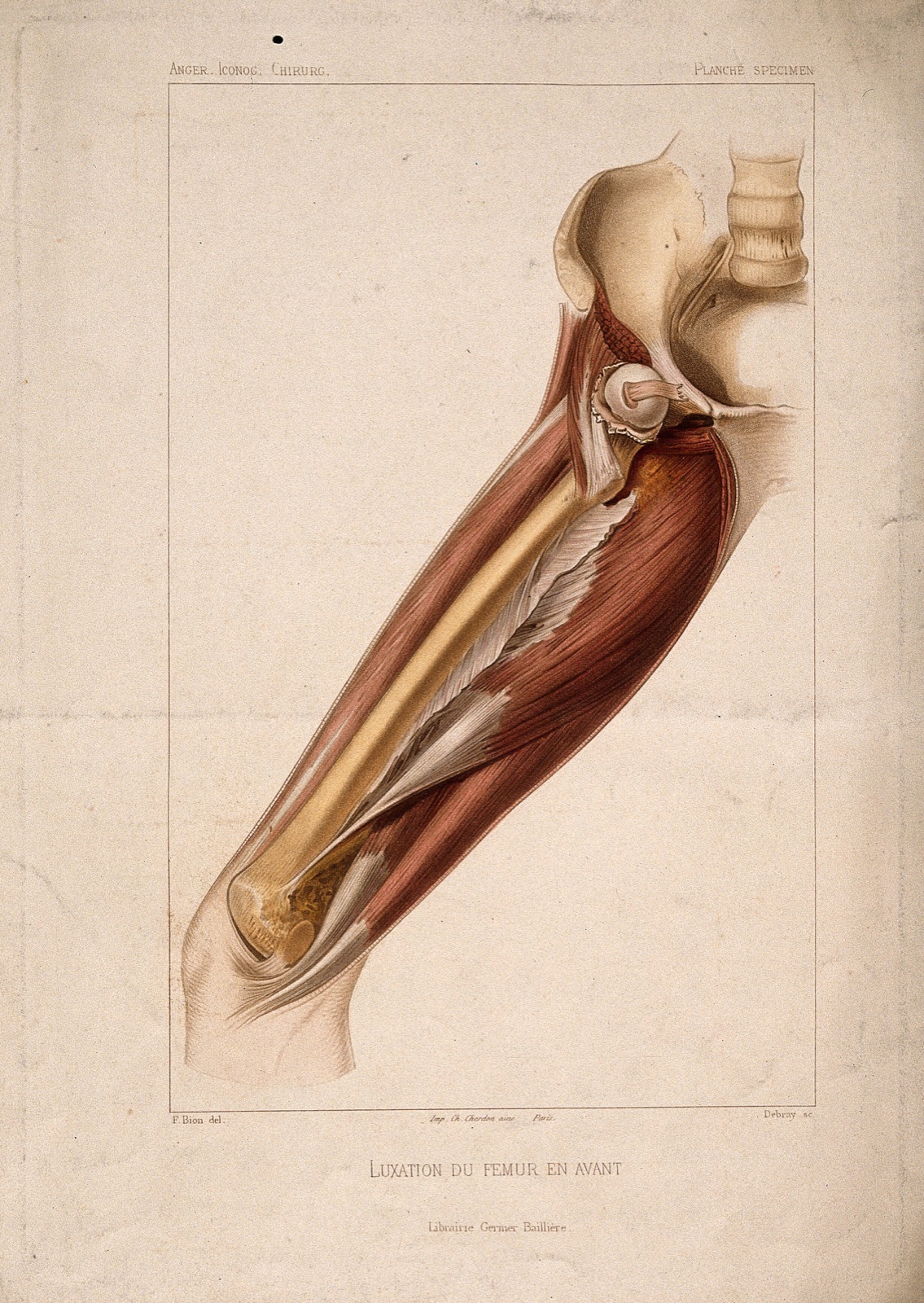 A dislocated femur bone: dissection of the thigh, showing the bone and surrounding muscles. Coloured stipple engraving by Debray after Bion, ca. 1870?. — Bion, F.; Debray